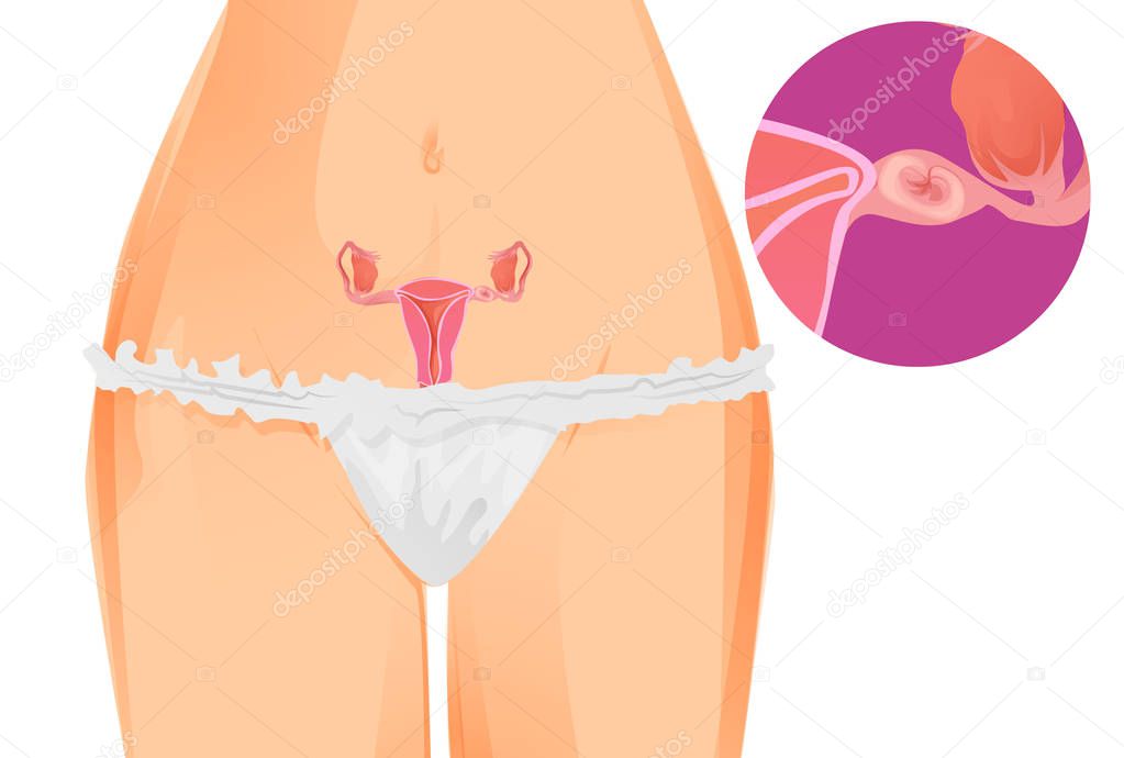 illustration of uterus with ectopic pregnancy in gynecology