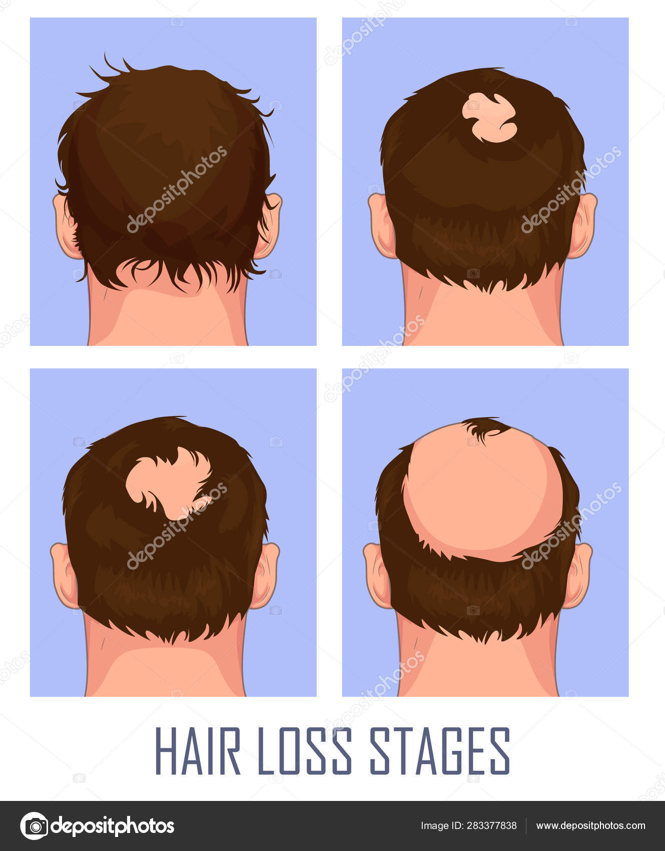 Hair loss. Stages of alopecia man problem vector medical health illustration Stock Vector Image by ©enotmutant #283377838 Hair loss. Stages of alopecia man problem vector medical health illustration Stock Vector Image by ©enotmutant #283377838