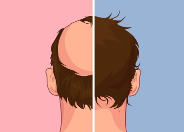 Saç dökülmesi. Alopesi adam sorun vektör tıbbi sağlık illüstrasyon Aşamaları Sonra önce