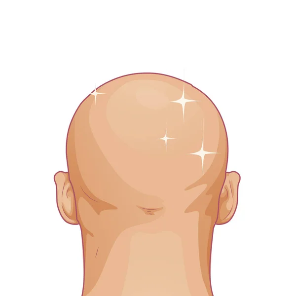 Hair loss. Bald hairstyle alopecia man problem vector medical health illustration — Stock Vector