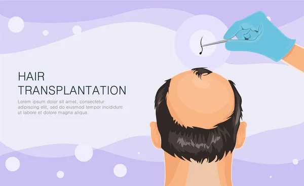 Caída de cabello. Etapas de alopecia hombre problema vector salud médica ilustración Trasplante de cabello ilustración — Archivo Imágenes Vectoriales