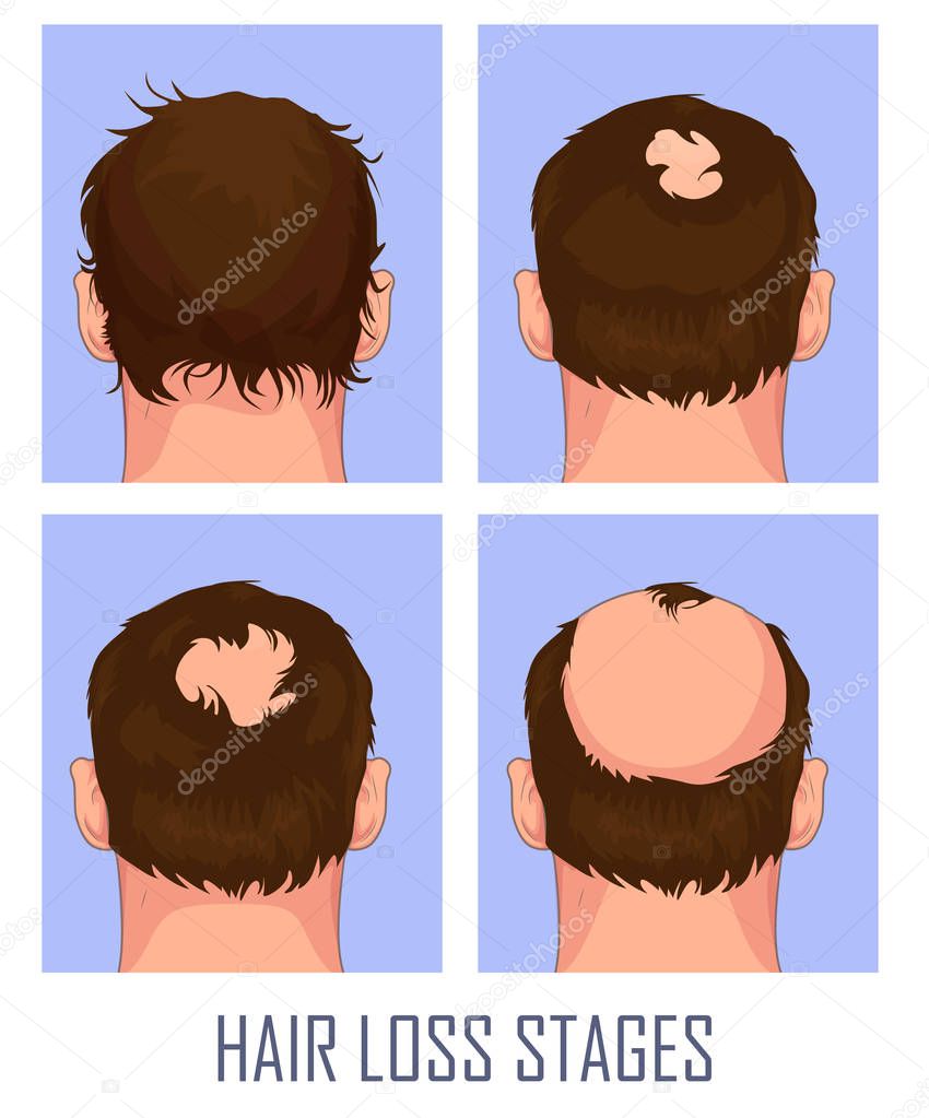 Hair loss. Stages of alopecia man problem vector medical health illustration