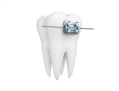 Beyaz izole diş telleri ile diş. Sağlık, tıp, diş doktoru, diş kliniği veya diş hekimi sembolü. 3D render