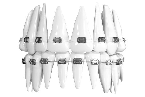 Kvalitet tandvård modell med hängslen, på vit bakgrund. Fotorealistiska illustration av en vita tänder hängslen. Tänder-ikonen isolerad på vit bakgrund. 3D render. Tandvård, medicin, hälsokoncept — Stockfoto