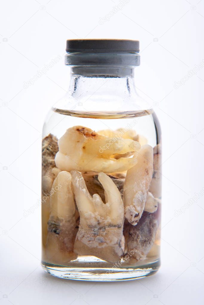 Concept - dentist's trophy. Set of removed teeth in a glass medical vial with ethyl alcohol. Macro