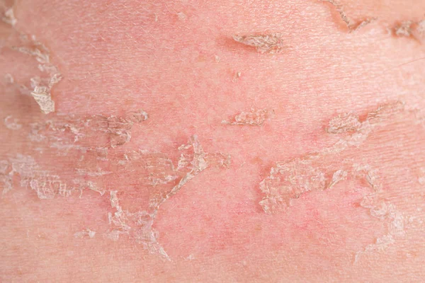 Zonnebrand van lichaam close-up. Huid beschadigd door de zon, peeling. Lichaamsverzorging thema — Stockfoto
