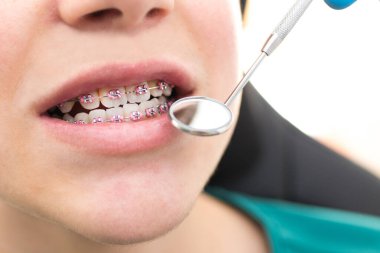 diş hekimi araçları ve ayna ile ağız bakarak