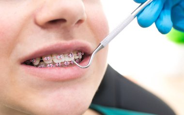 diş teli ve dişçi aletli ağız