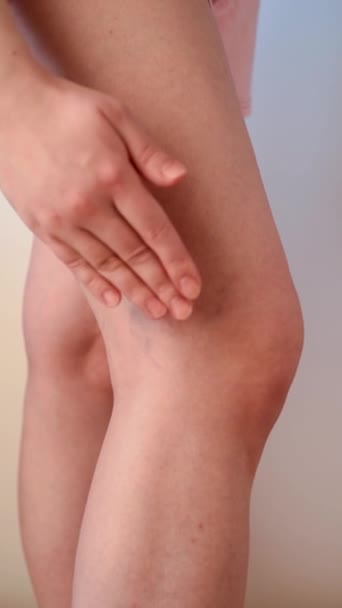 Varices Une Femme Lubrifie Côté Genou Avec Crème Mode Vie — Video