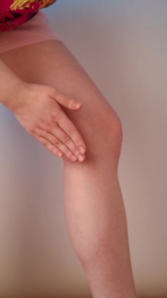 Venas Varicosas Una Mujer Lubrica Lado Rodilla Con Crema Estilo — Vídeo de stock