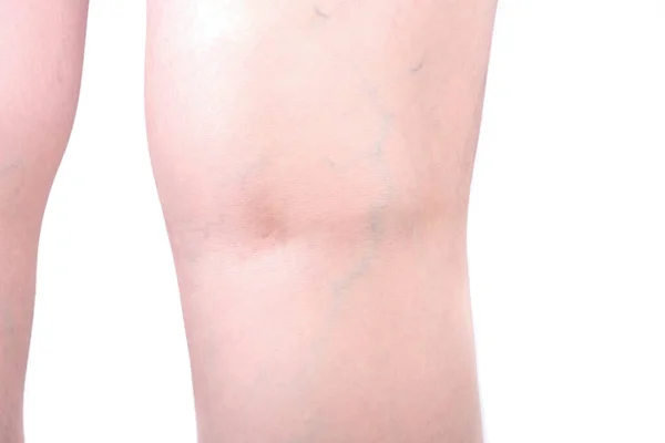 Varicose veins on the back of the knee. Healthy lifestyle. Close up.