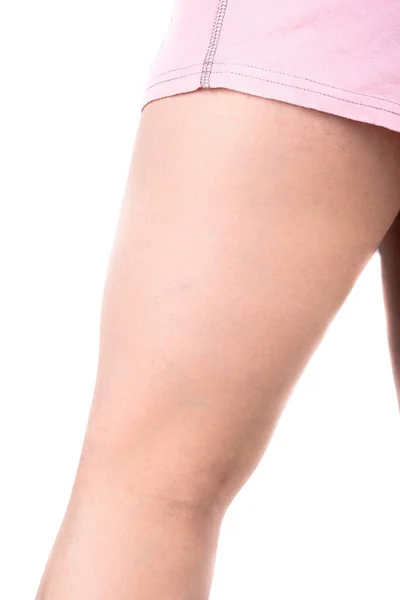 Varicose Veins Back Female Leg Healthy Lifestyle Close — Stock Photo, Image