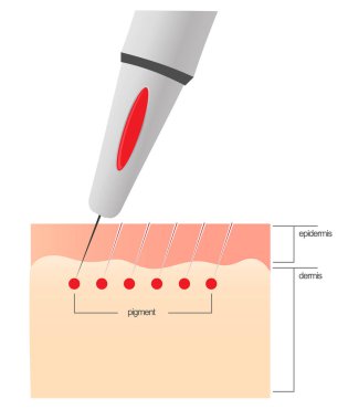 The scheme of the procedure of permanent makeup. clipart