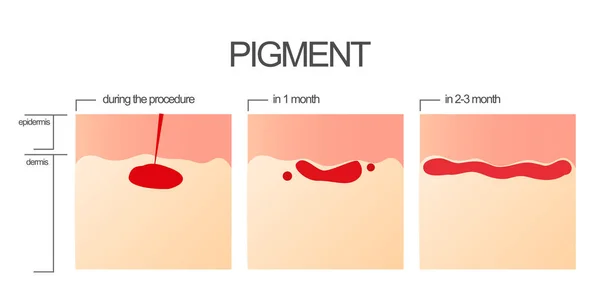 Le processus de greffe du pigment après la procédure de salon de maquillage permanent . — Photo