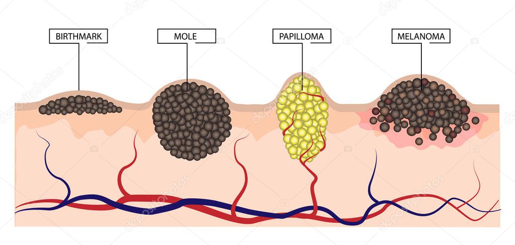 The difference between a birthmark, mole, papilloma and melanoma. Infographics. Illustration