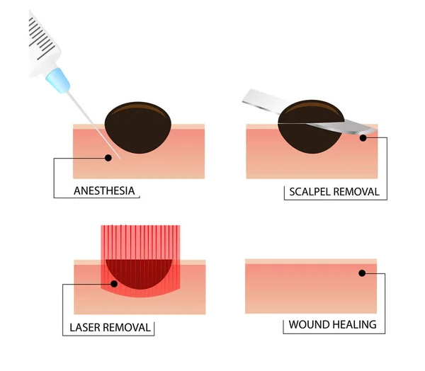 Laser removal of moles. A phased scheme of the procedure. — Stock Photo, Image