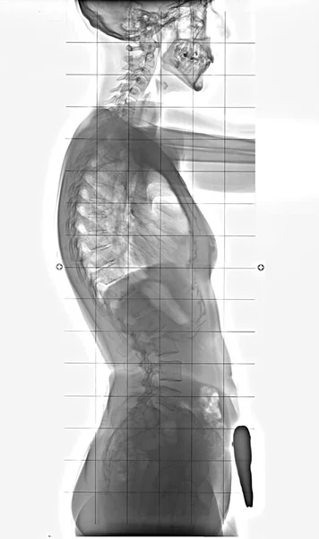 人間の体は 完全脊髄 脊柱後弯症 サイドビューに胸からの — ストック写真
