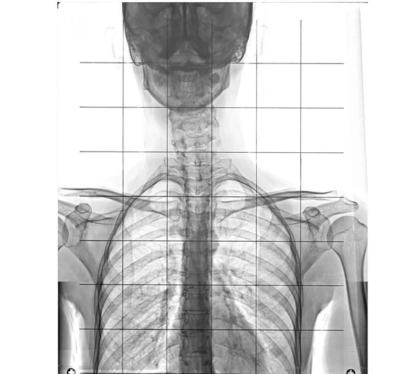 Ray Human Chest Spinal Column Front View — Stock Photo, Image