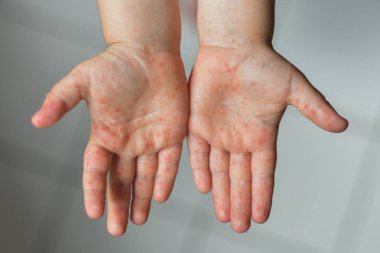 Enterovirüs Bacak Ağzı Bir Cocksackie virüsünün vücudunda döküntü