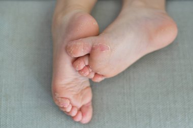 Enterovirus Bacak kol ağzı Deri bir çocuk Cocksackie virüs vücudunda kapalı soyulmuş