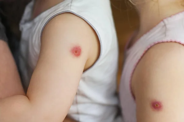 Mãos Crianças Com Reação Vacina Bcg — Fotografia de Stock