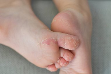 Enterovirüs ayak ağızlı Cocksackie virüsünün derisi soyulmuş.