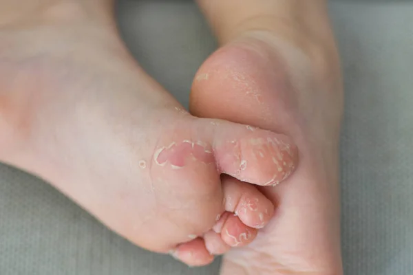 ( 영어 ) Enterovirus foot hand skin off on the body of a child Cockie virus — 스톡 사진