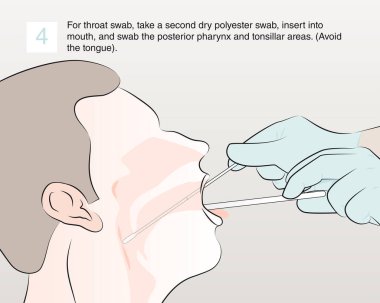4. adım: Boğazdan örnek almak için ikinci bir polyester çubuk alın, ağzınıza sokun ve arka gırtlağı ve bademcikleri temizleyin. Dilden uzak dur.).
