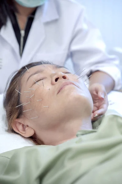 Asijské Žena Prochází Akupunktura Krása Tváře Léčby — Stock fotografie