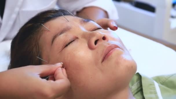 Asian Woman Undergoing Acupuncture Beauty Face Treatment Electric Needle Therapy — Stock Video