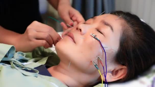 Acupunctura Fata Femeii Spitalul Cosmetic — Videoclip de stoc