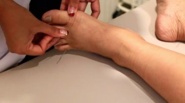 Alternatif doktor tarafından insan bacağı üzerinde akupunktur