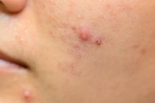 Young Asia Woman Showing Her Face Acne Moles — Stock Photo, Image