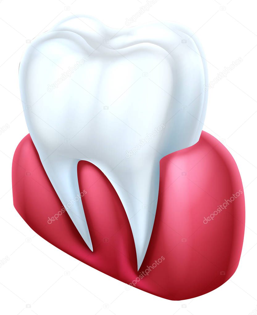 A dental cutaway medical illustration of a tooth and gum
