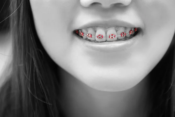 Donna Asiatica Sorridente Con Braccialetti Dentali Tono Bianco Nero — Foto Stock