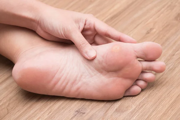 Eine Frau Die Unter Mais Ihrer Fußsohle Leidet — Stockfoto