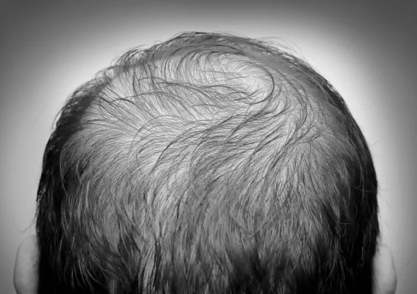 Close up man\'s head with hair loss, thinning hair or alopecia isolated on white background. Black and white tone. Hair problem.