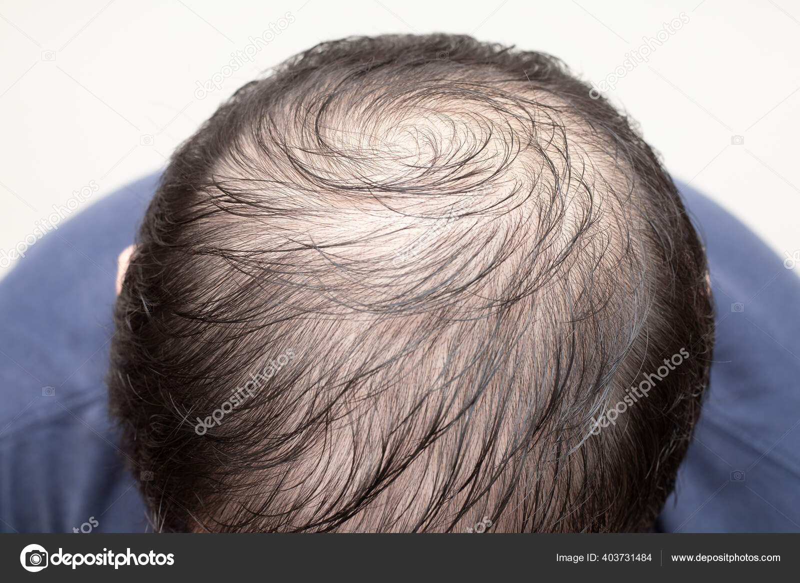 Bandit pianist Kirsebær Close Top View Man's Head Hair Loss Thinning Hair Alopecia Stock Photo by  ©catinsyrup 403731484