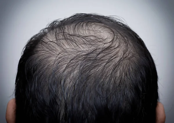 Nahaufnahme Des Kopfes Eines Mannes Mit Haarausfall Schütterem Haar Oder — Stockfoto