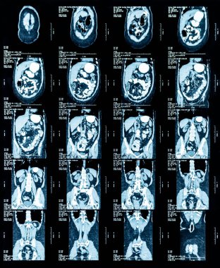 Göğüs ve karın manyetik rezonans görüntüsü (MRI)