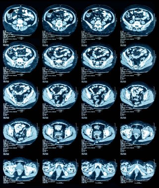 Göğüs ve karın manyetik rezonans görüntüsü (MRI)