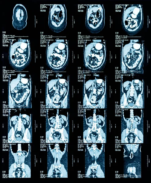 胸部と腹部の磁気共鳴画像 Mri — ストック写真