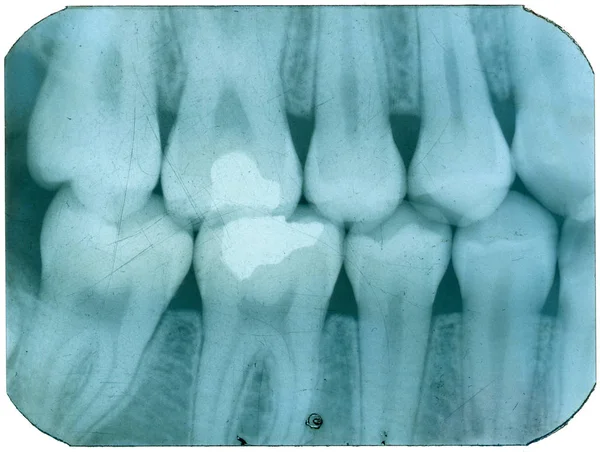 Stary Dental Rentgenowskie Zębów Złym Stanie — Zdjęcie stockowe