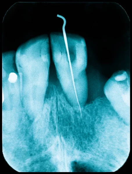 Παλιά Ακτινογραφία Δοντιών Δόντια Κακή Κατάσταση — Φωτογραφία Αρχείου