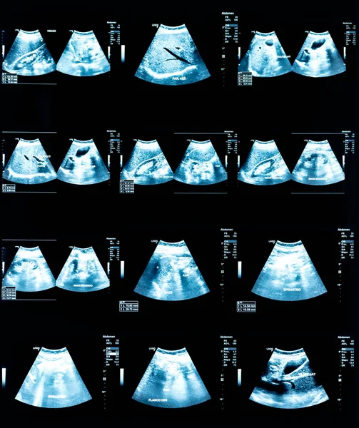 Echography Image (Ultrasound) of abdomen — Stock Image Echography Image Ultrasound Abdomen Royalty Free Stock Images