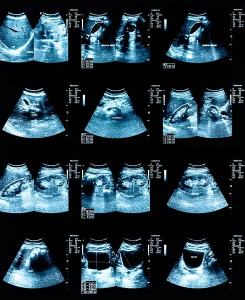 Echography Image (Ultrasound) of abdomen — Stock Image Echography Image Ultrasound Abdomen Stock Photo