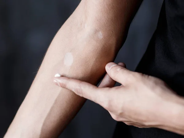 Vitiligo close-up bem mãos em um fundo preto — Fotografia de Stock