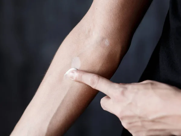 Vitiligo close-up bem mãos em um fundo preto — Fotografia de Stock