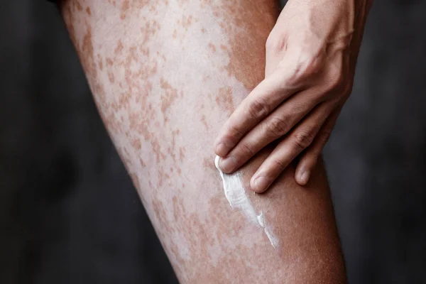 Vitiligo nos pés da pele, cuidados com a pele ha — Fotografia de Stock