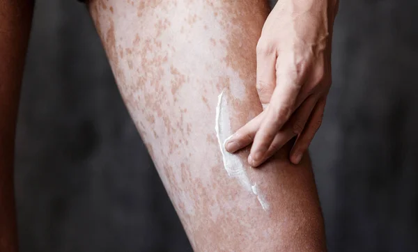 Vitiligo nos pés da pele, cuidados com a pele ha — Fotografia de Stock